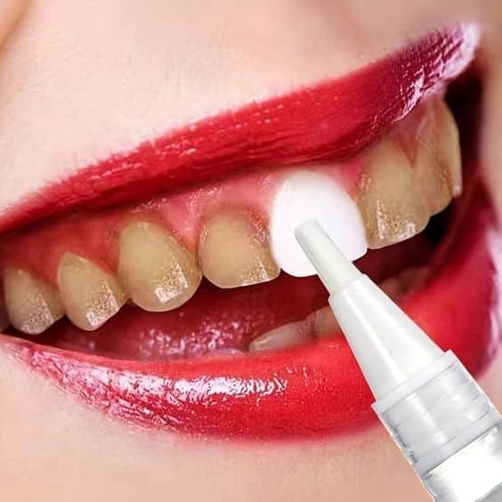 Blanchiment Des Dents