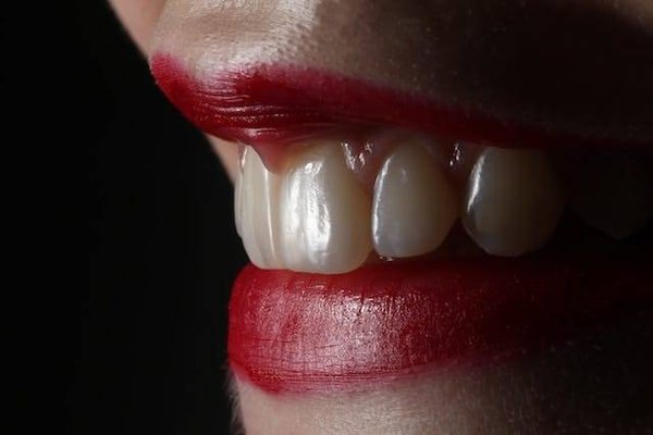 Quels sont les avantages psychologiques du blanchiment des dents ?