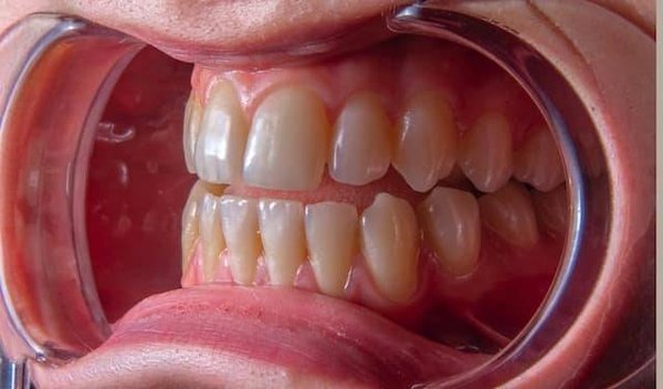 Quels sont les meilleurs remèdes naturels pour blanchir les dents ?